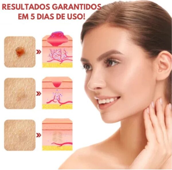 WipeOFF® - Remova Verrugas, Manchas e Marcas (COMPRE 3 LEVE 5) - Image 5
